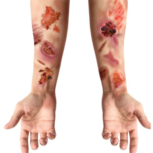 Tatouages fausses plaies infectées